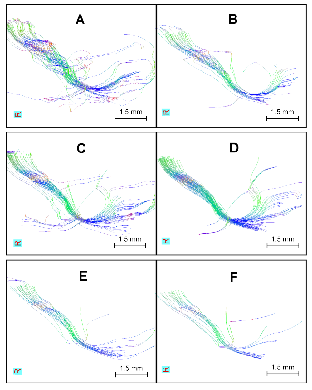 Sagittal views of the Corticospinal tract (CST) in different spatial resolutions. From top to bottom: tested resolutions (0.2mm^3, 0.3mm^3 and 0.4mm^3). Left column (A-E): CST in MoD. Right column (B-F): CST in averaged images. B is obtained from T-Avg_6 in Figure 9a. Replicating a likely execution framework in longitudinal studies. Pairs C-D and E-F corresponds to MoD bars and \ast \ast in Figure 8b and 8c respectively. 