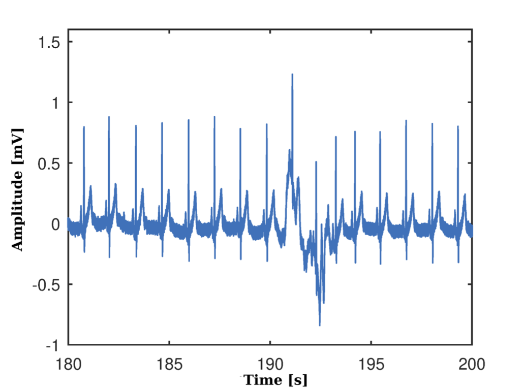 After applying of the notch filter, elimination of the non-linear trend of the ECG and oversampled to 1KHz